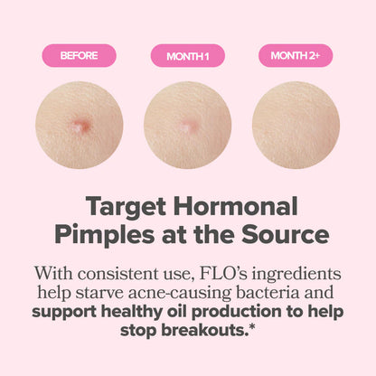 Hormonal ACNE Vitamin Capsules